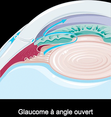 glaucome angle ouvert